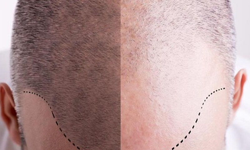 Micro FUE Hair Transplant 